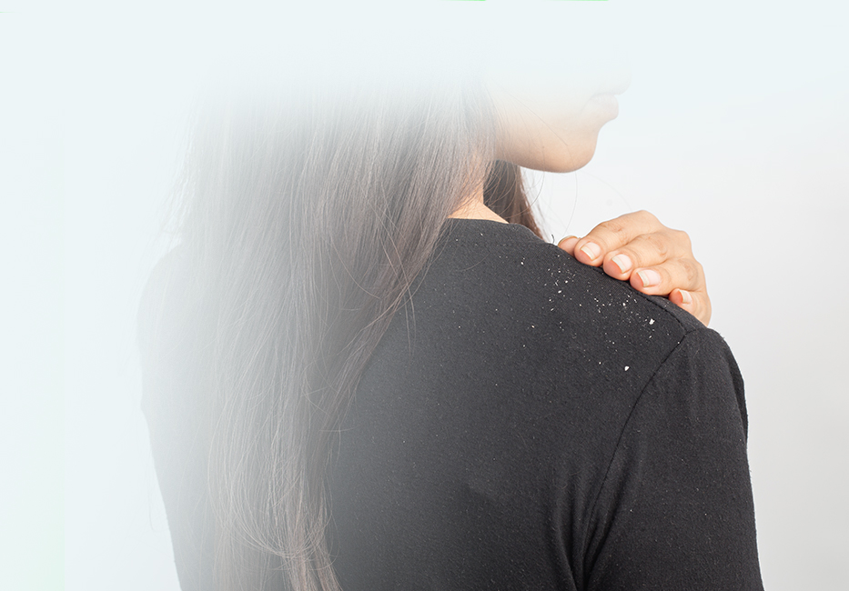 Dandruff Dandruff
