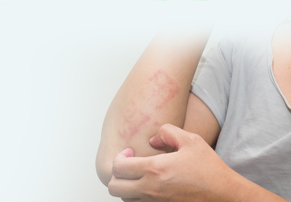 Eczema & Psoriasis Eczema & Psoriasis