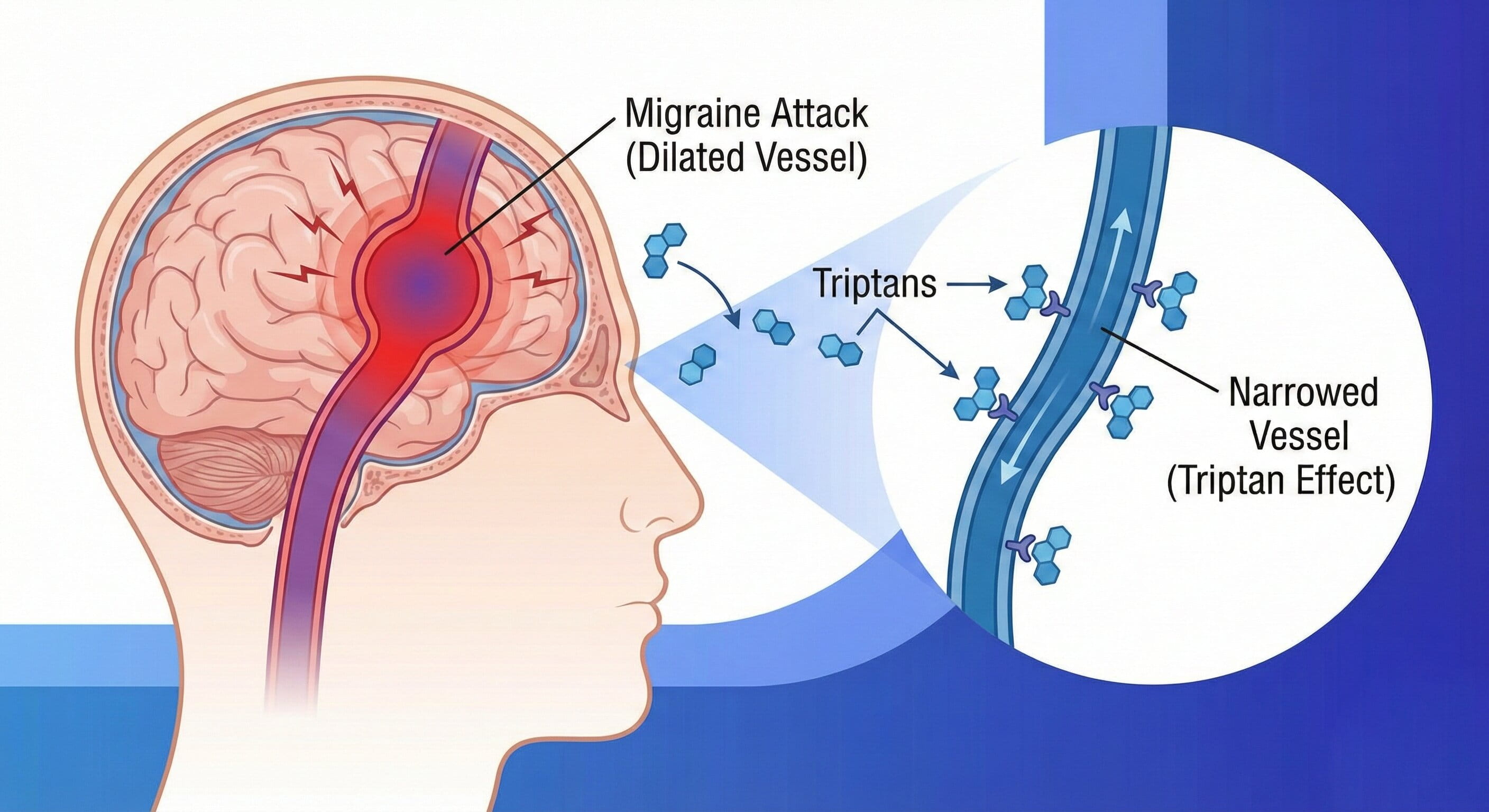 How triptans narrow blood vessels in the brain during a migraine attack